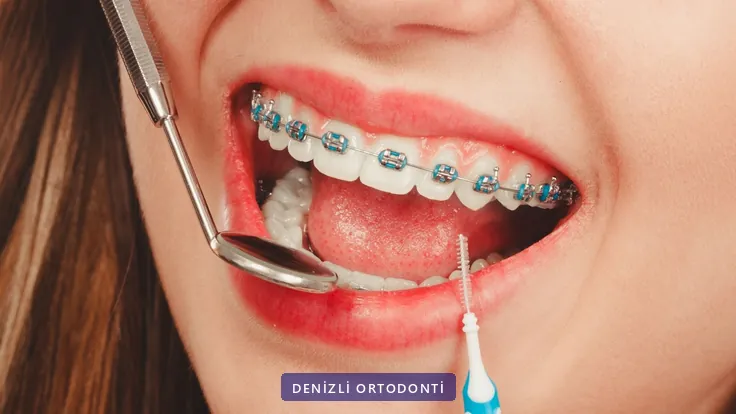 Braketli dişlerin ağız aynası ve arayüz fırçasıyla kontrol edilmesi