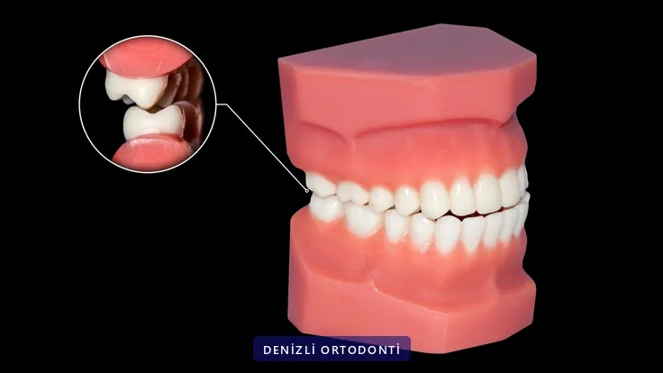 Çapraz kapanışı büyütülmüş ayrıntıyla gösteren çene modeli