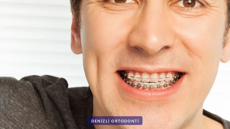 Metal braketli dişleriyle gülümseyen genç erkek hasta