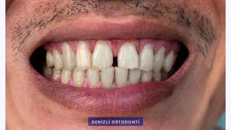 Ön dişler arasında belirgin boşluk bulunan bir gülüş