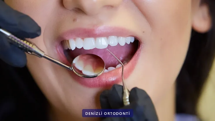 Ağız aynası ve sond ile yapılan rutin ortodonti kontrolü