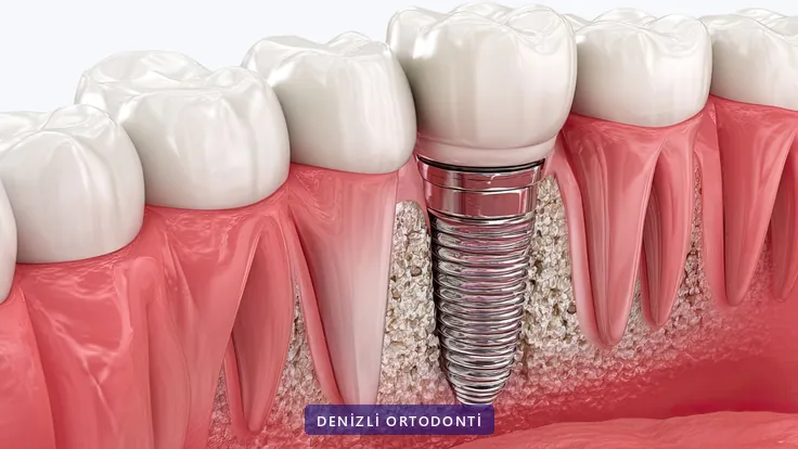 Diş eti ve kemik kesitinde mini vida yerleşimini gösteren üç boyutlu çizim