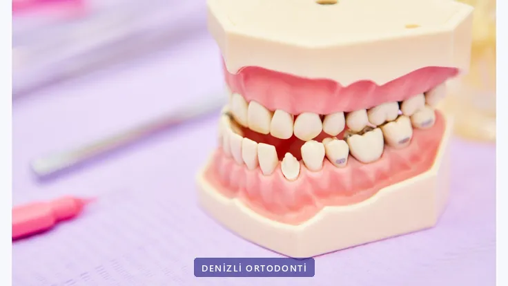 Çapraşık ve boşluklu dişleri gösteren eğitim amaçlı çene modeli
